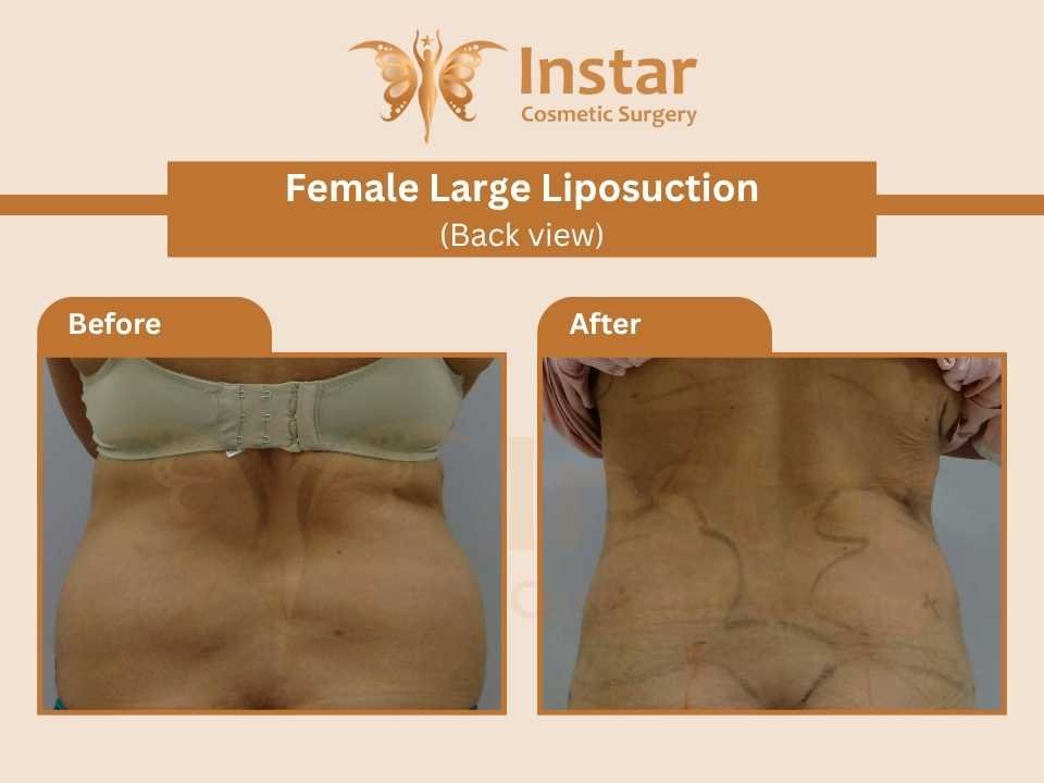 Female Large Liposuction (Back view)-2